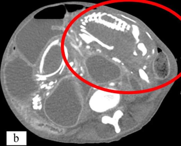 Shown above is a scan of the calcified fetus inside the mother. She died 14 months after coming to the US due to severe malnutrition