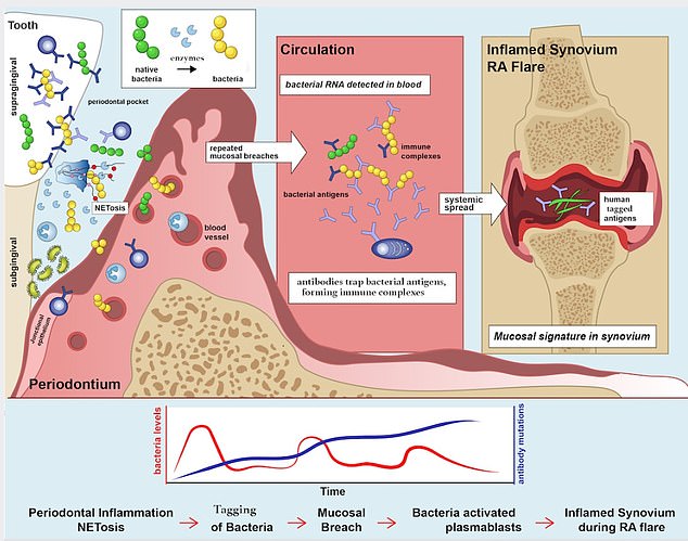 Tracing the connection between gum disease and RA could help develop therapies for the latter, an autoimmune inflammatory disease that attacks the lining of the joints and can cause heart, lung and eye problems