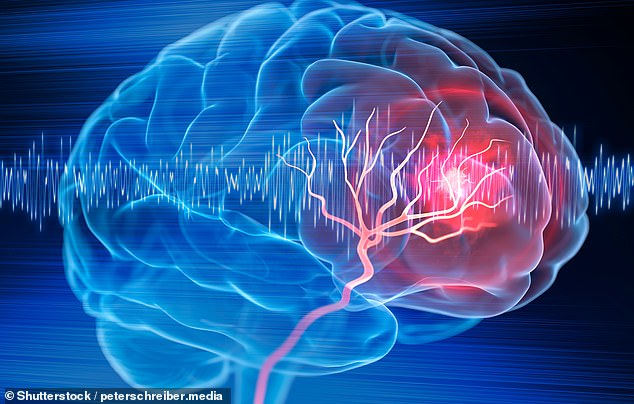 Stroke symptoms are commonly remembered with the four-letter acronym, FAST, which stands for face, arms, speech and time. Patients experiencing a stroke can often have their face drop on one side, struggle to lift both arms and have slurred speech, while time is essential, as immediate treatment for a transient ischemic attack (TIA) or minor stroke can substantially slash the risk of a much deadlier major stroke