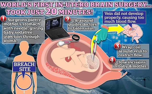 Scientists used an ultrasound to find nerves that would be affected by the rare one in 60,000 birth defect. Children born with this condition have a 30 percent chance of dying by age 11.