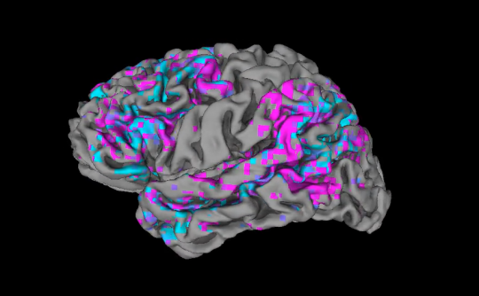 The fMRI monitors brain activity when the subject is hearing or thinking words