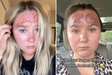 Urgent warning to check sunscreen bottles after woman reveals horror 'burn'