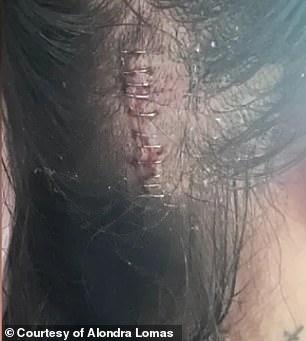Alondra's staples in her head from an operation she had in the hospital