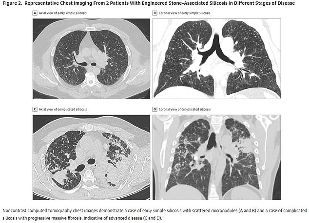 Pictured above are X-rays of the lungs of workers who have developed silicosis