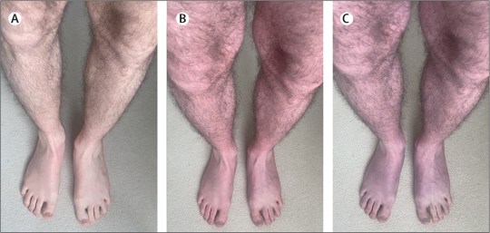 The patient at 0 minutes, 2 minutes and 10 minutes after standing