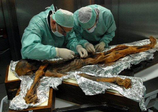 *EMBARGOED UNTIL 16.00 BST, WED AUG 16 (11.00 ET)* A stomach content sampling campaign in November 2010 in Bolzano, Italy where scientists took samples of Otzi's last meals. See SWNS story SWSCiceman. ??tzi the Iceman was dark-skinned and bald, according to new research. Initial artist's impression of the early human showed him with light skin and long hair. But fresh analysis of the remains of the man dubbed ??tzi, who lived around 5,300 years ago, reveals he actually had dark skin and male pattern baldness. The mummified body was found by German tourist Helmut Simon on a glacier in the Tirolean ??tztal Alps, on the Italian-Austrian border, on September 19, 1991. Radiocarbon-dated to 3300 BC, the body is that of a man aged 25 to 35 who was about 5 feet 2 inches (1.6 metres) tall and had weighed around 110 pounds (50 kilos). It was originally believed he had fallen victim to exposure or exhaustion while crossing the Alps and froze to death. But X-ray examination in 2001 showed that an arrowhead was lodged in his left shoulder, suggesting that he had likely bled to death. Now researchers have used state of the art technology to generate a much higher quality genome to learn more about his genetic history- and found some surprises.