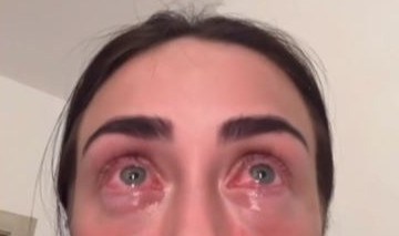 My face ballooned & I was hospitalised after I got eyelash extensions