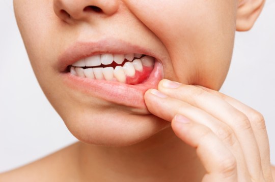 The gum disease periodontitis is linked with heart conditions