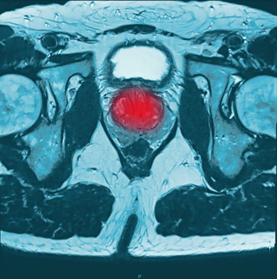 Mandatory Credit: Photo by Voisin/Phanie/REX/Shutterstock (3753246d) Magnetic resonance imaging (MRI) scan of a section through the pelvis of a with prostate cancer (red at centre). Various
