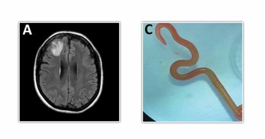 Live worm found in Australian womans brain in world firsty discovery