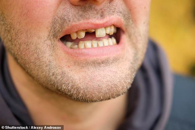 Half of those who have suffered dental injuries from an epileptic seizure, such as broken or chipped teeth, have not had them repaired due to the steep cost of treatment, according to the Epilepsy Society