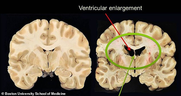 The above scan shows the brain of a healthy 27-year-old (left) and that of an individual with CTE (right). These were presented by Dr Ann McKee, a neurologist at Boston University, while presenting the results of a separate study