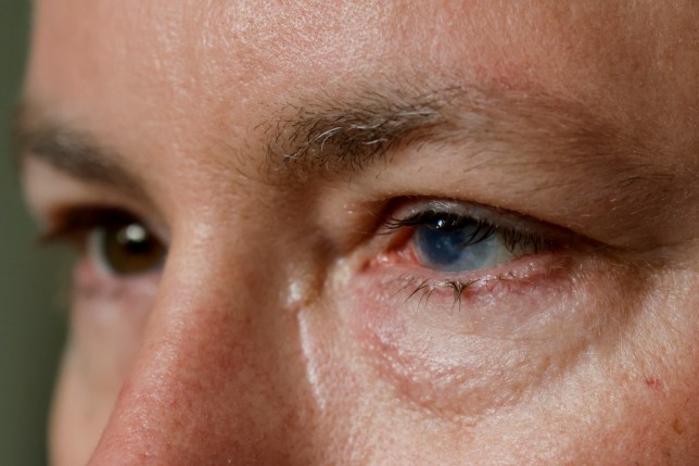 stem cells from a patient’s healthy eye are removed and then expanded and grown on a graft (Picture: AP Photo/Butch Dill)