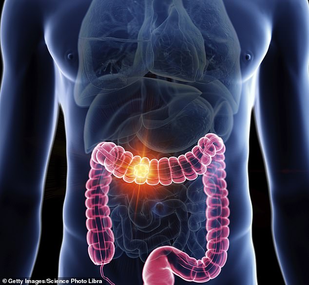 When given with radiotherapy and chemotherapy, durvalumab can destroy cancers in the lower part of the bowel ¿ removing the need for an operation