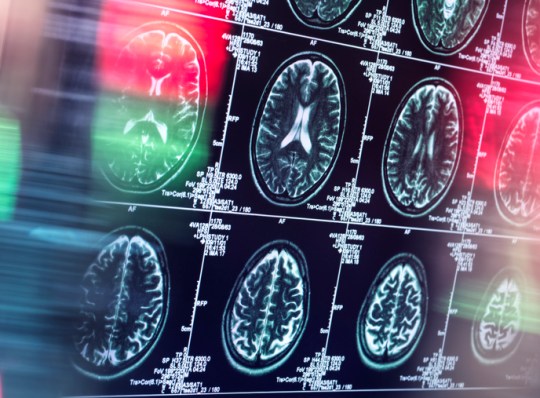 Scientists were surprised that less than 10 hours of sitting did not have any affect on dementia risk