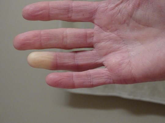 Raynaud's causes poor circulation