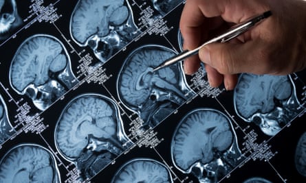 Close-up of a hand holding a pen while pointing at an MRI scan of a brain