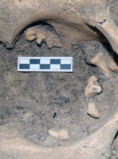 Rare tumor with teeth discovered in Egyptian burial from 3,000 years ago