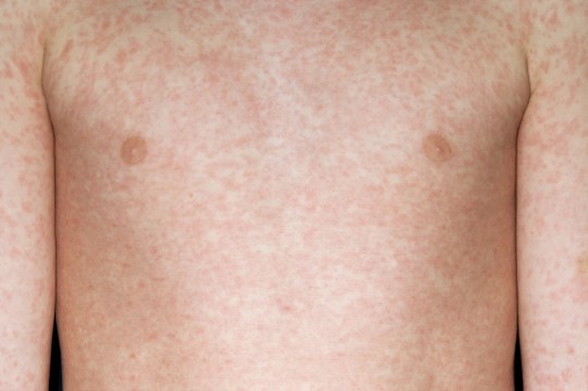 Measles rash