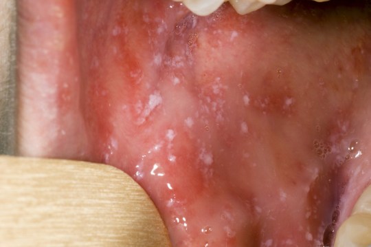 Small white spots may appear around the inside of the mouth