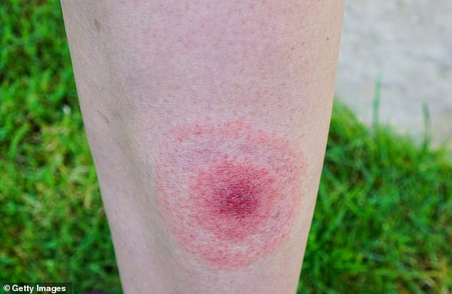 Deer ticks carry Lyme disease, a bacterial infection that causes a bulls-eye-shaped rash and flu-like symptoms (pictured)