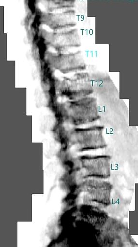 A scan of Ruth's spine