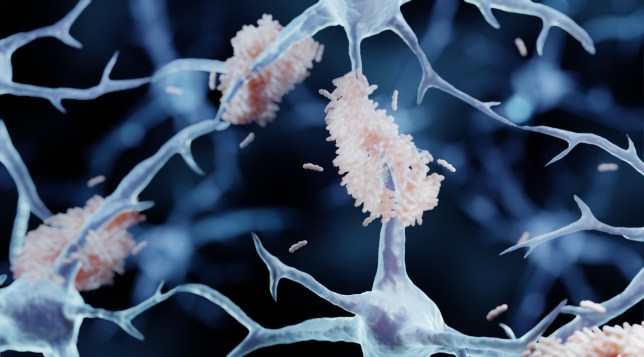 Amyloid plaques in Alzheimer's disease