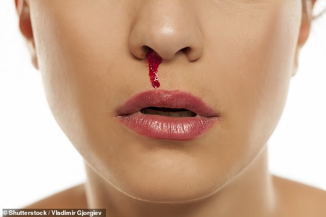 The best way to stop a nosebleed is to lean forward and pinch the end of the nose for 15 minutes, according to NHS guidance.