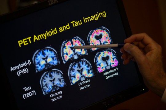 FILE - A doctor points to PET scan results that are part of a study on Alzheimer's disease at Georgetown University Hospital, on Tuesday, May 19, 2015, in Washington. (AP Photo/Evan Vucci, File)