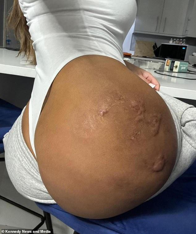 Pictured: a recent image of Monique's buttocks more than a year after getting botched bum filler with just scarring left