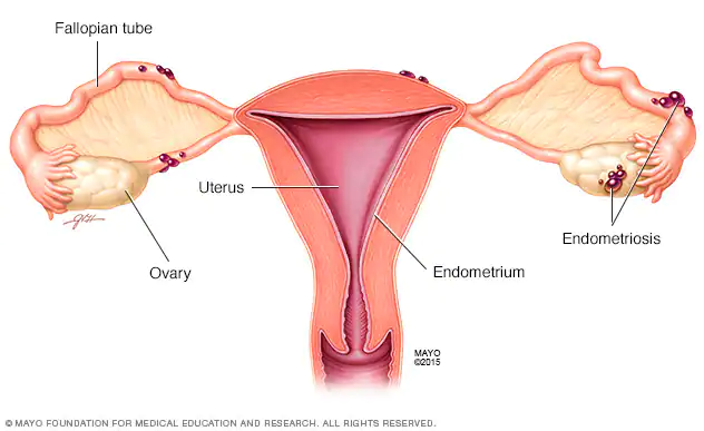 Endometriosis: What Are The Signs And How Can It Be Treated