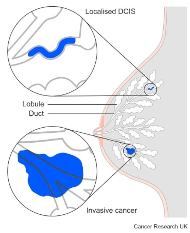 Under current UK guidance, treatment to tackle the early stage cancer involves surgery which may then be followed by radiotherapy to kill off any abnormal cells lurking in the breast tissue