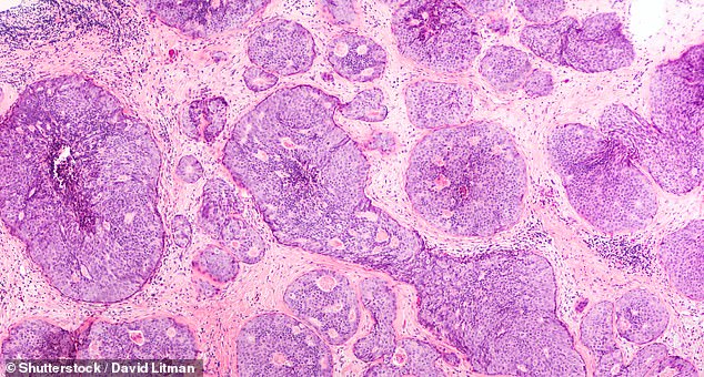 Ductal carcinoma in situ, or DCIS, is a a slow-growing type of the disease which is contained in the milk ducts and routinely picked up by screening. Pictured, DCIS in breast tissue